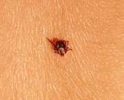 Embedded tick